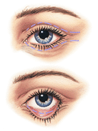 Blepharoplasty