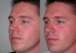 Closed approach rhinoplasty for overprojecting tip