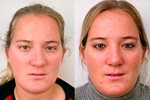 Revision rhinoplasty external approach frontal view