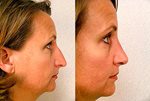 Primary closed rhinoplasty lateral views