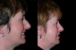Rhinoplasty approach with excision of the fracture line