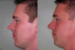 Closed approach rhinoplasty for overprojecting tip
