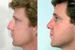 External rhinoplasty for post traumatic nasal deformity trauma