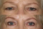 Upper lid blepharoplasty