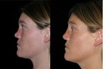 Rhinoplasty for saddle nose (lateral view)