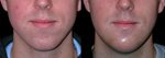 Chin Augmentation