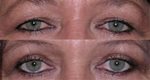 Blepharoplasty