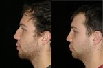 Treatment of repeated trauma to the nose over the years from boxing